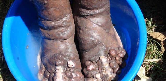 Manche Betroffene leben schon über zwanzig Jahre mit der Krankheit. Aber auch nach viel weniger Zeit können die Füße bereits so schlimm wie auf diesem Foto sein.